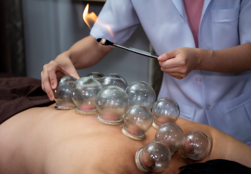 Fire cupping therapy image